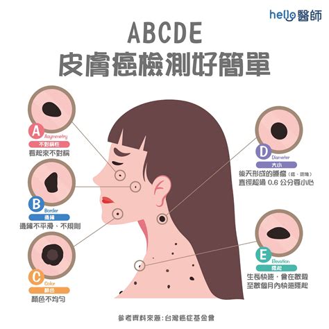 身上痣多|痣形成的原因？痣長毛、痣變多變大是痣病變？5招判別